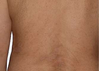 Photo from an Otezla patient's lower back with PASI-80 score at week 16