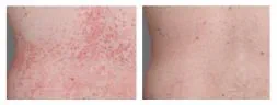 Thumbnail of plaque psoriasis PASI-69 results at week 16 on the back of an Otezla patient