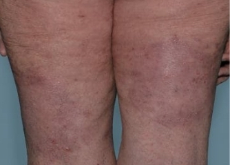 Photo from an Otezla patient's knees with PASI-75 score at week 16